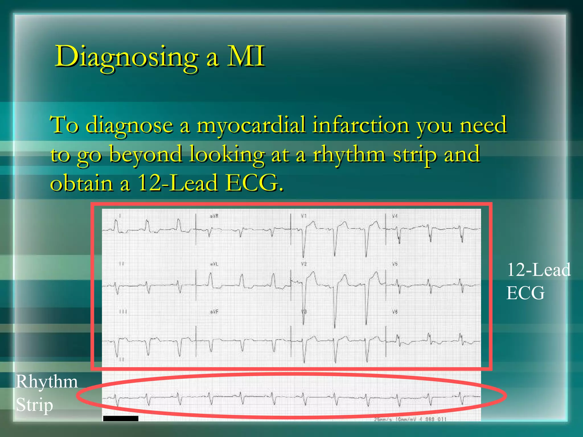 Diagnosing a MI To diagnose a myocardial infarction you need to go beyond looking at a rhythm strip and obtain a 12-Lead ECG. Rhythm Strip 12-Lead ECG 