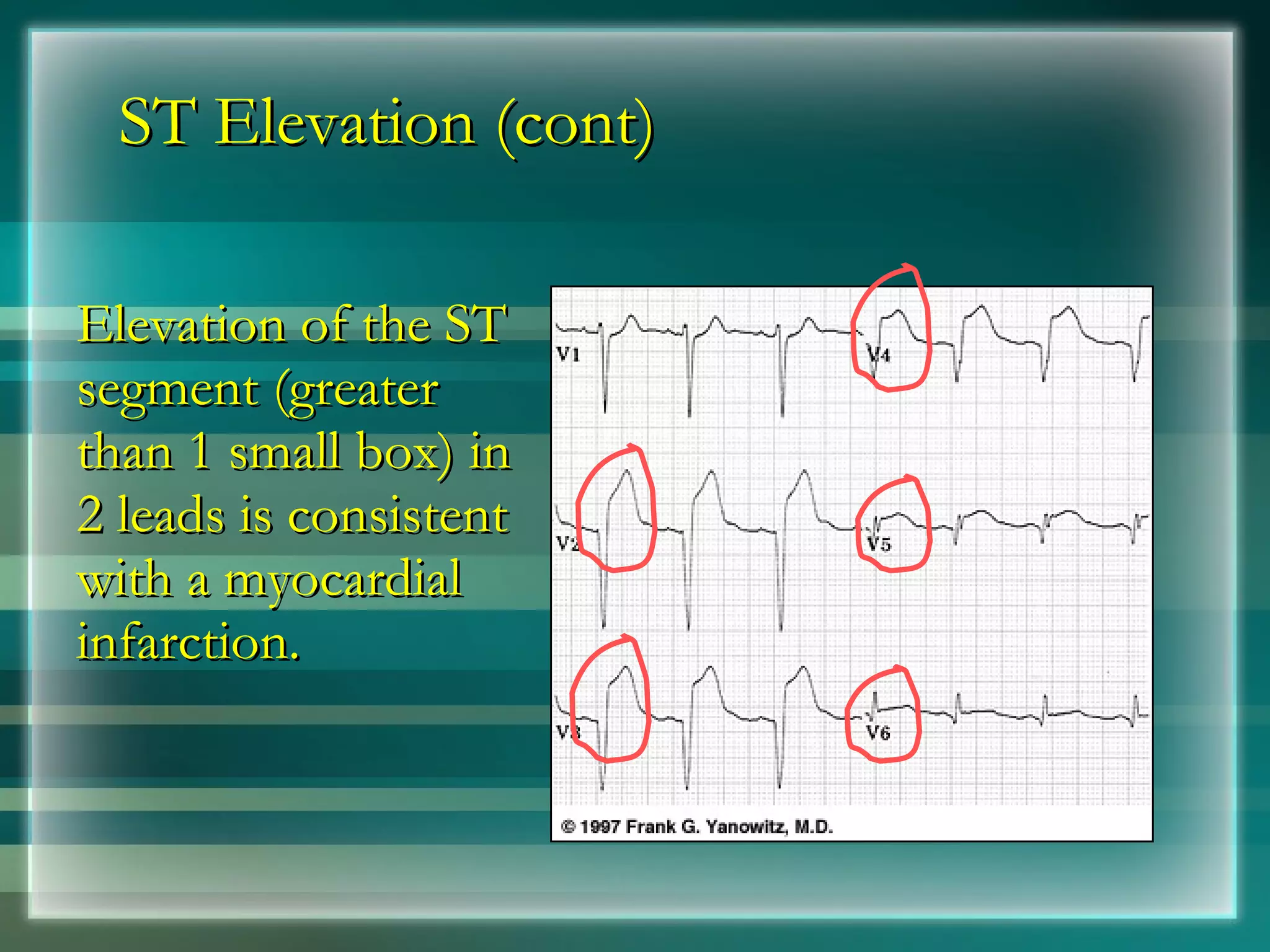 ST Elevation (cont) Elevation of the ST segment (greater than 1 small box) in 2 leads is consistent with a myocardial infarction. 