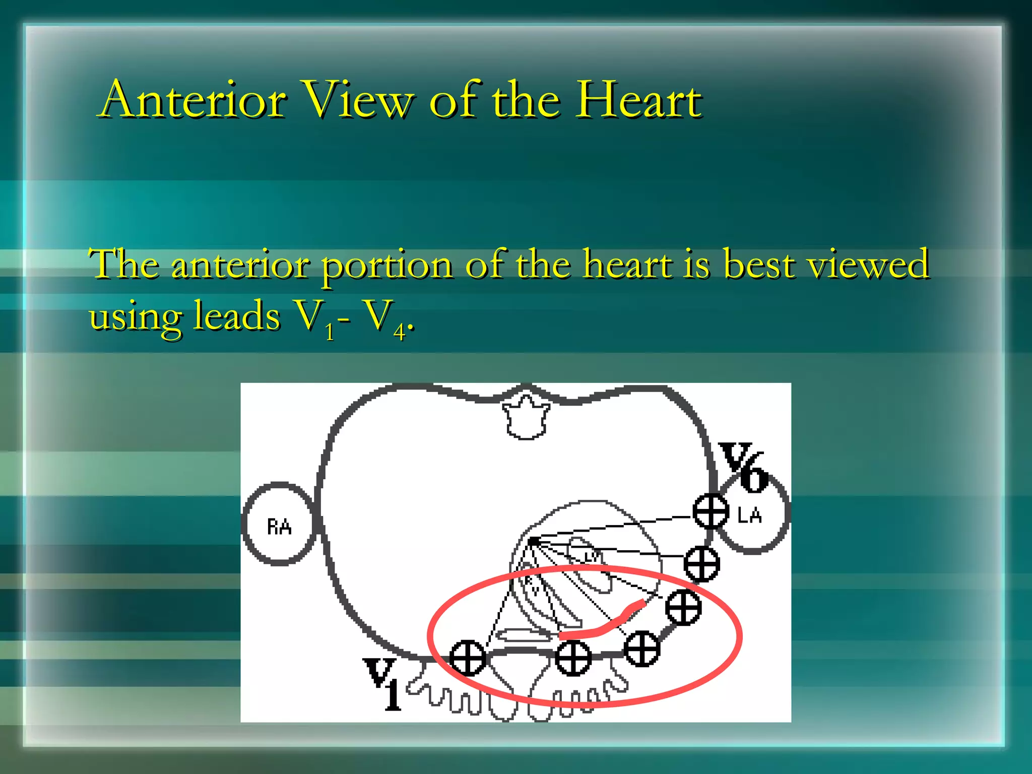 Anterior View of the Heart The anterior portion of the heart is best viewed using leads V 1 - V 4 . 