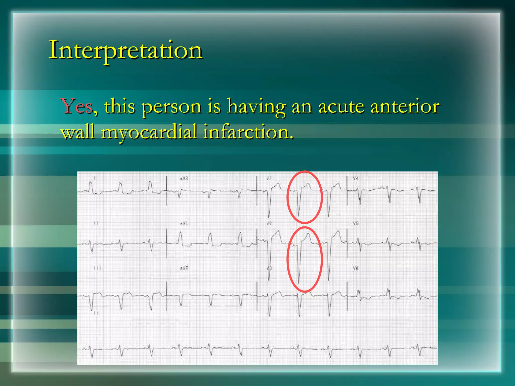 Interpretation Yes , this person is having an acute anterior wall myocardial infarction. 