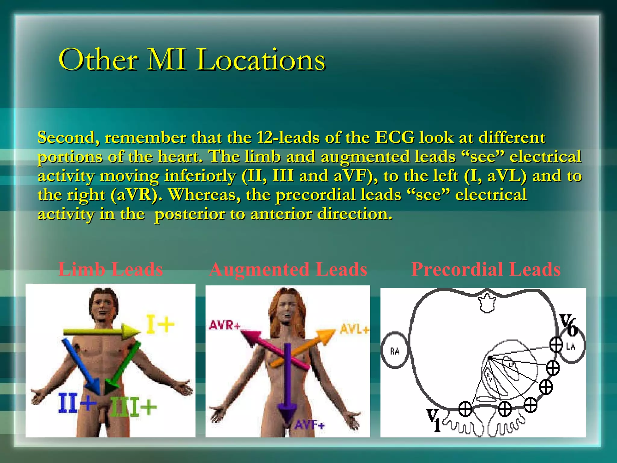 Other MI Locations Second, remember that the 12-leads of the ECG look at different portions of the heart. The limb and augmented leads “see” electrical activity moving inferiorly (II, III and aVF), to the left (I, aVL) and to the right (aVR). Whereas, the precordial leads “see” electrical activity in the  posterior to anterior direction. Limb Leads Augmented Leads Precordial Leads 