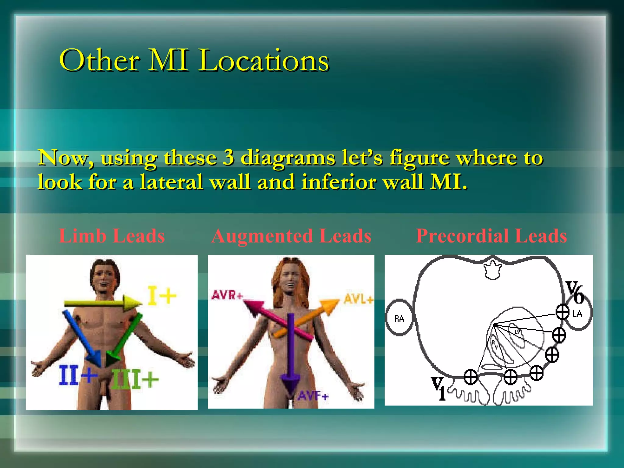 Other MI Locations Now, using these 3 diagrams let’s figure where to look for a lateral wall and inferior wall MI. Limb Leads Augmented Leads Precordial Leads 