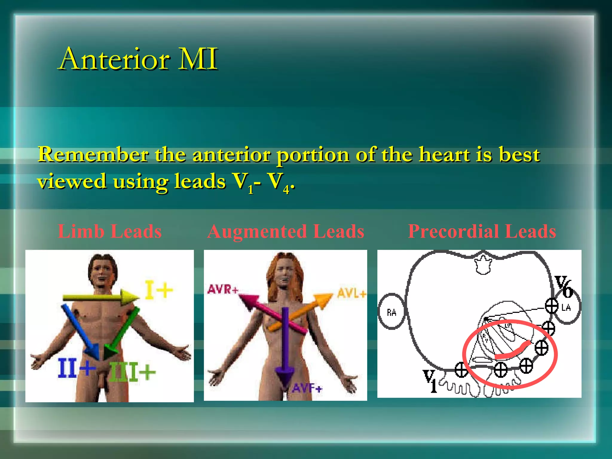 Anterior MI Remember the anterior portion of the heart is best viewed using leads V 1 - V 4 . Limb Leads Augmented Leads Precordial Leads 