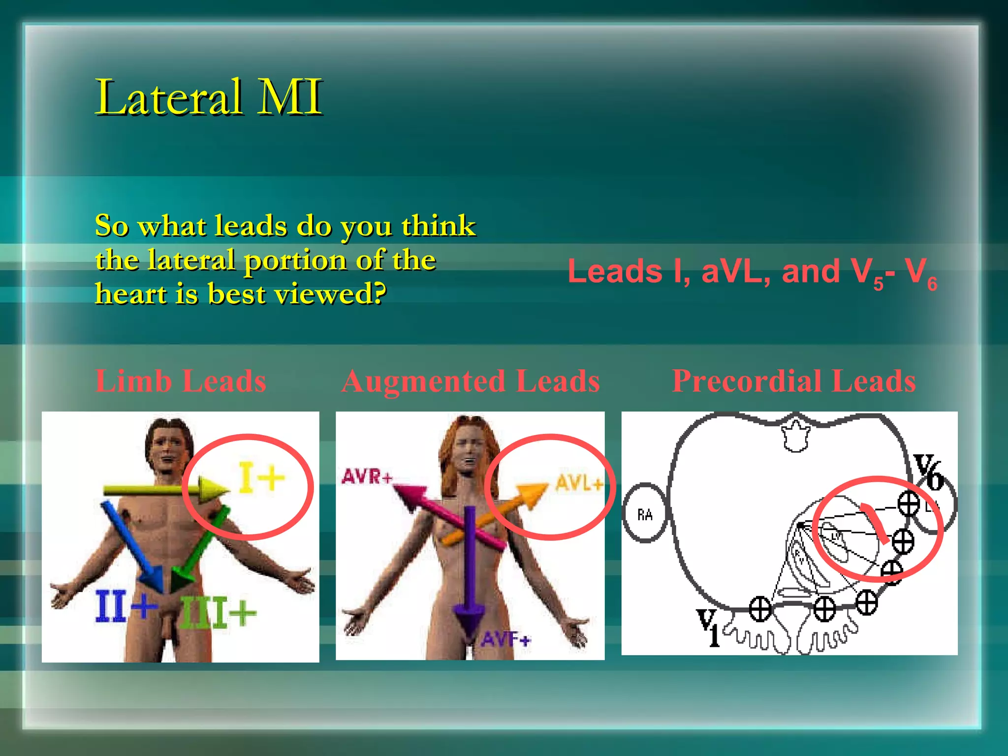Lateral MI So what leads do you think the lateral portion of the heart is best viewed?  Limb Leads Augmented Leads Precordial Leads Leads I, aVL, and V 5 - V 6 