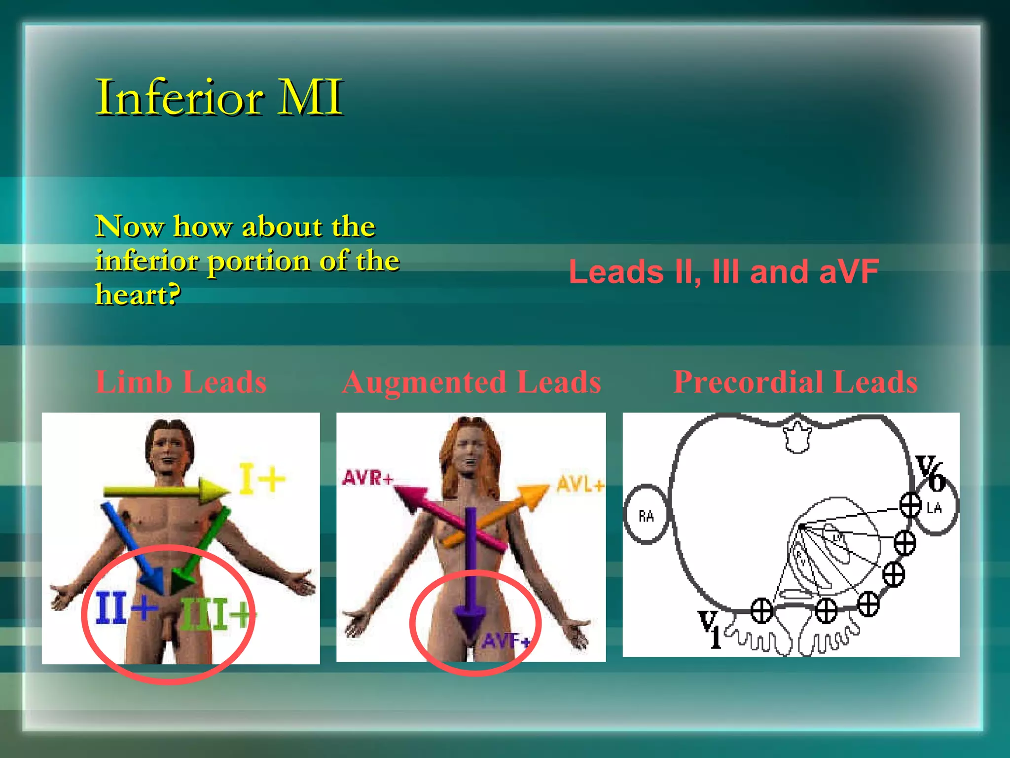 Inferior MI Now how about the inferior portion of the heart?  Limb Leads Augmented Leads Precordial Leads Leads II, III and aVF 