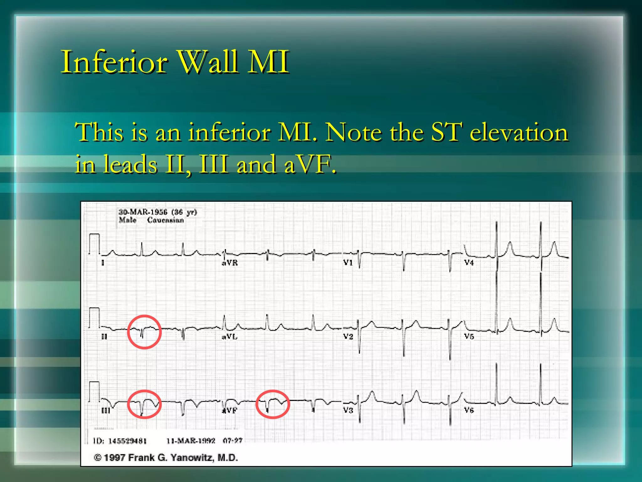 Inferior Wall MI This is an inferior MI. Note the ST elevation in leads II, III and aVF. 