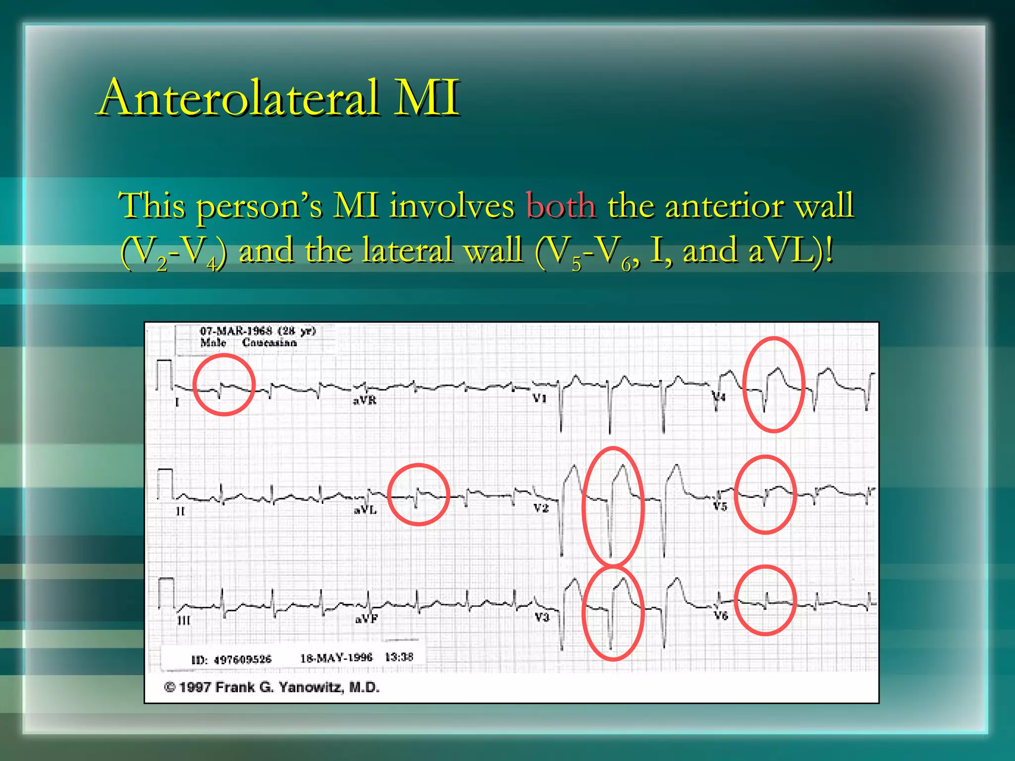 Anterolateral MI This person’s MI involves  both  the anterior wall (V 2 -V 4 ) and the lateral wall (V 5 -V 6 , I, and aVL)! 