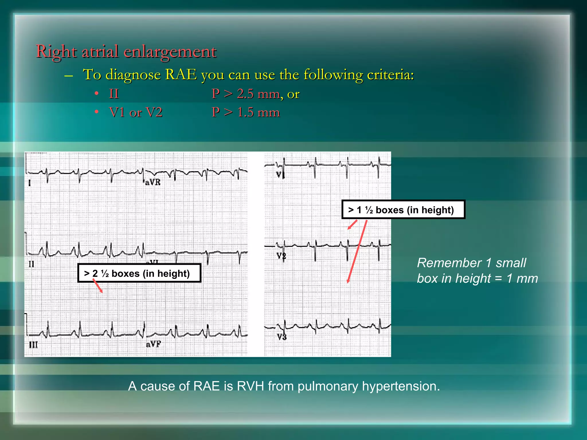 Right atrial enlargement   To diagnose RAE you can use the following criteria: II P > 2.5 mm , or V1 or V2 P > 1.5 mm Remember 1 small box in height = 1 mm A cause of RAE is RVH from pulmonary hypertension. > 2 ½ boxes (in height) > 1 ½ boxes (in height) 