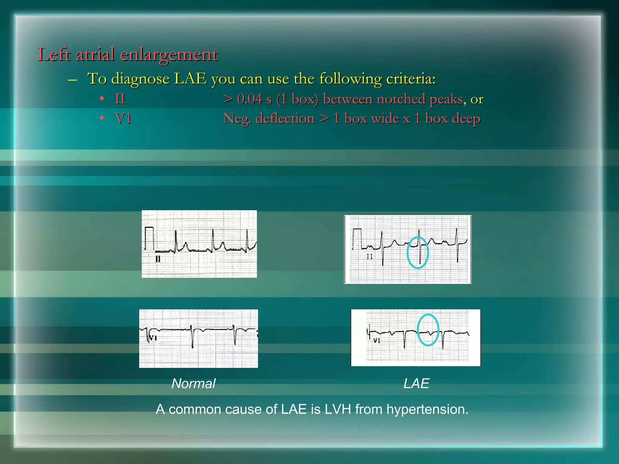 Left atrial enlargement   To diagnose LAE you can use the following criteria: II > 0.04 s (1 box) between notched peaks , or V1 Neg. deflection > 1 box wide x 1 box deep Normal LAE A common cause of LAE is LVH from hypertension. 