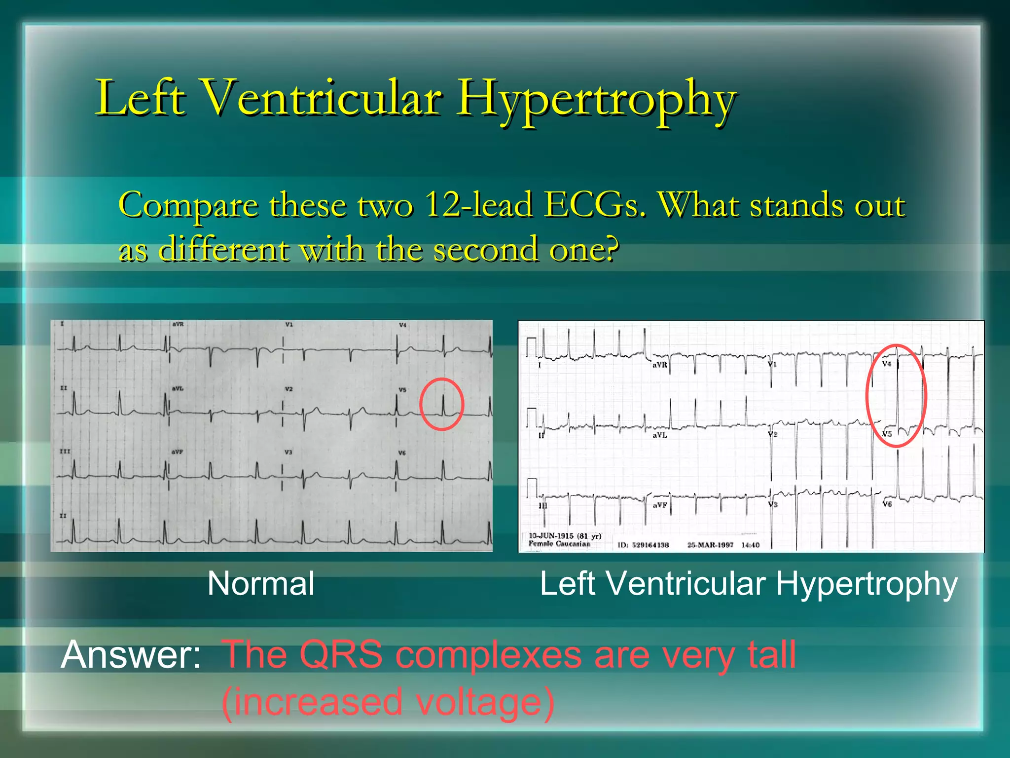Left Ventricular Hypertrophy Compare these two 12-lead ECGs. What stands out as different with the second one? Normal Left Ventricular Hypertrophy Answer: The QRS complexes are very tall (increased voltage) 