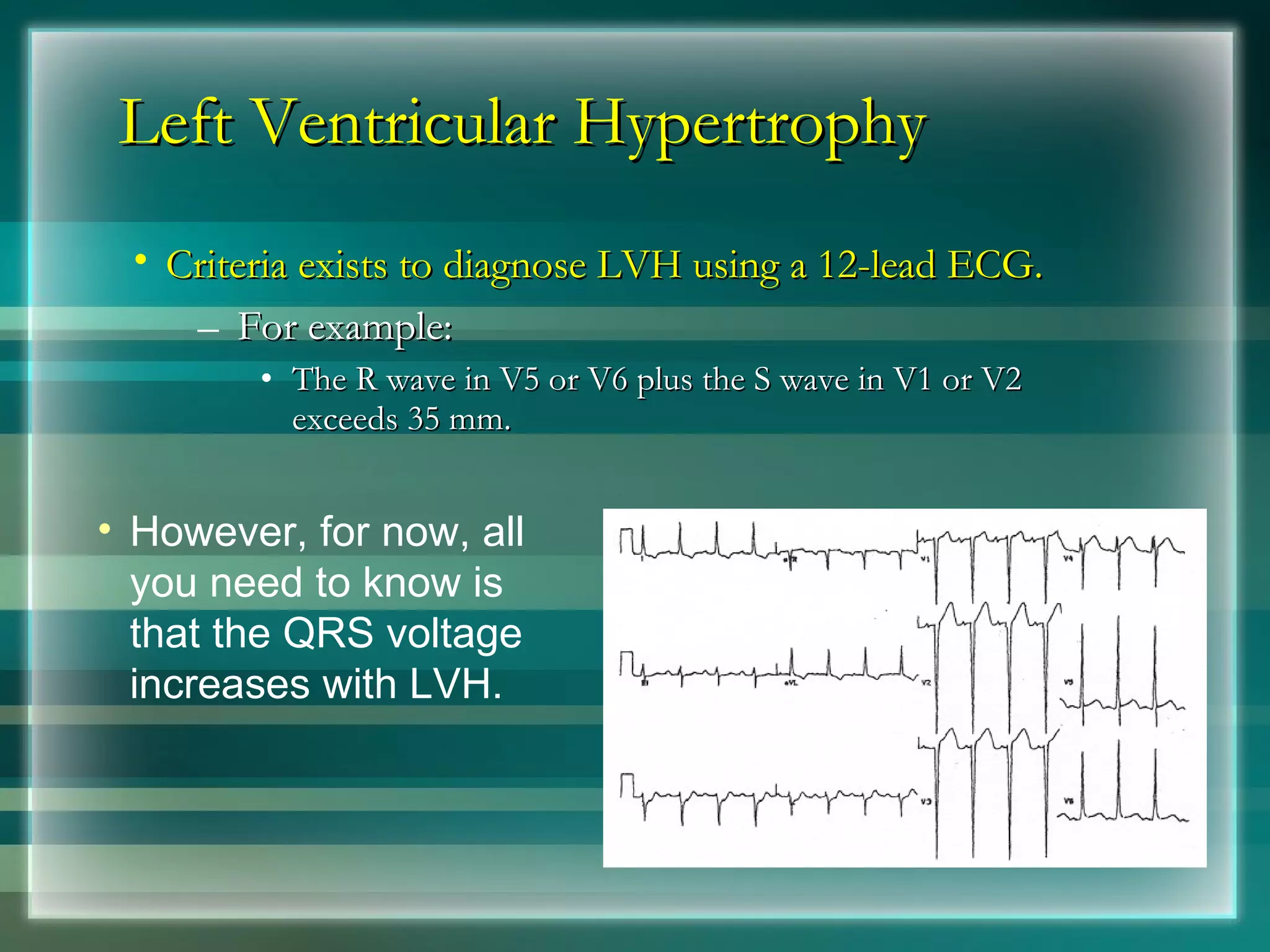 Left Ventricular Hypertrophy Criteria exists to diagnose LVH using a 12-lead ECG.   For example: The R wave in V5 or V6 plus the S wave in V1 or V2 exceeds 35 mm. However, for now, all you need to know is that the QRS voltage increases with LVH. 