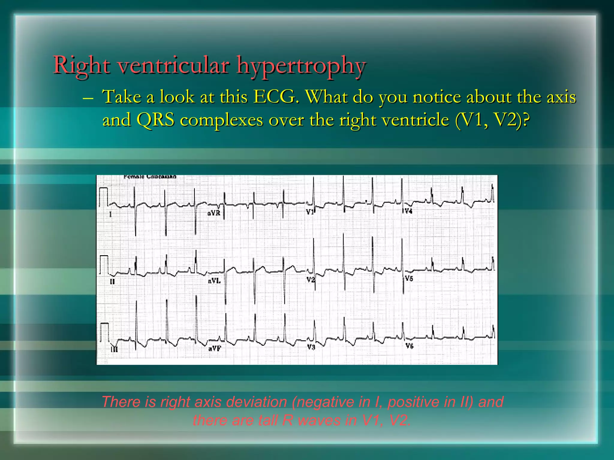 Right ventricular hypertrophy Take a look at this ECG. What do you notice about the axis and QRS complexes over the right ventricle (V1, V2)? There is right axis deviation (negative in I, positive in II) and there are tall R waves in V1, V2. 