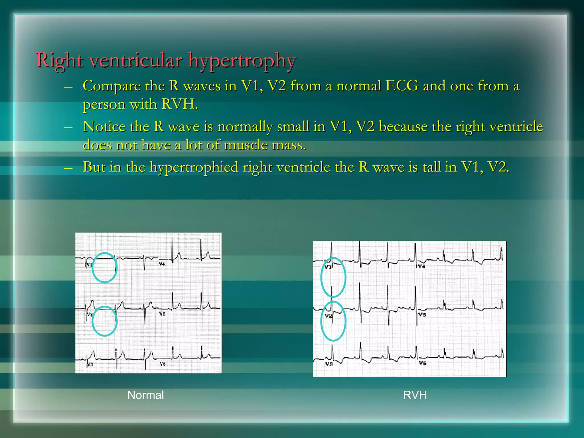 Right ventricular hypertrophy Compare the R waves in V1, V2 from a normal ECG and one from a person with RVH. Notice the R wave is normally small in V1, V2 because the right ventricle does not have a lot of muscle mass. But in the hypertrophied right ventricle the R wave is tall in V1, V2. Normal RVH 