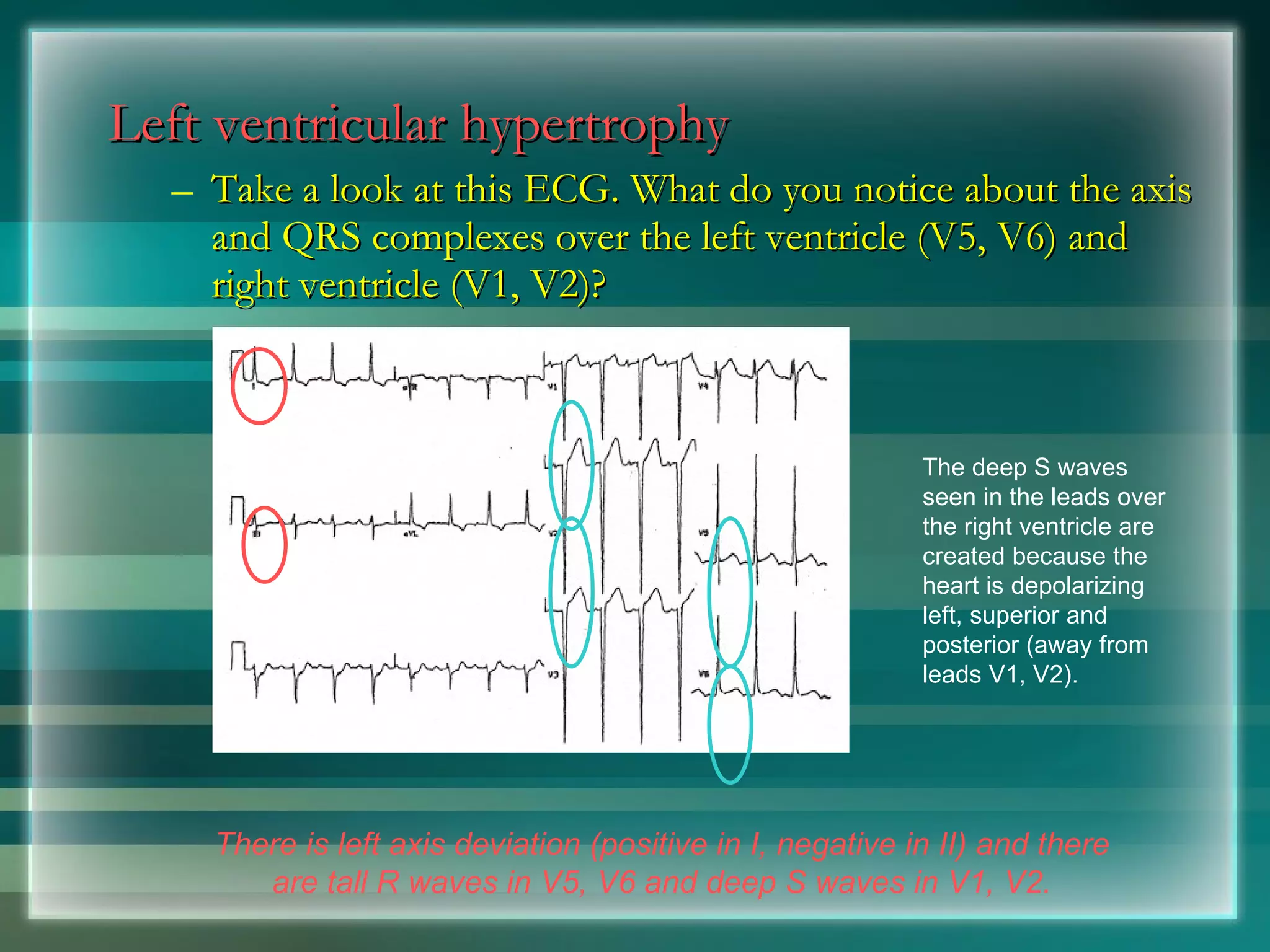 Left ventricular hypertrophy Take a look at this ECG. What do you notice about the axis and QRS complexes over the left ventricle (V5, V6) and right ventricle (V1, V2)? There is left axis deviation (positive in I, negative in II) and there are tall R waves in V5, V6 and deep S waves in V1, V2. The deep S waves seen in the leads over the right ventricle are created because the heart is depolarizing left, superior and posterior (away from leads V1, V2).  