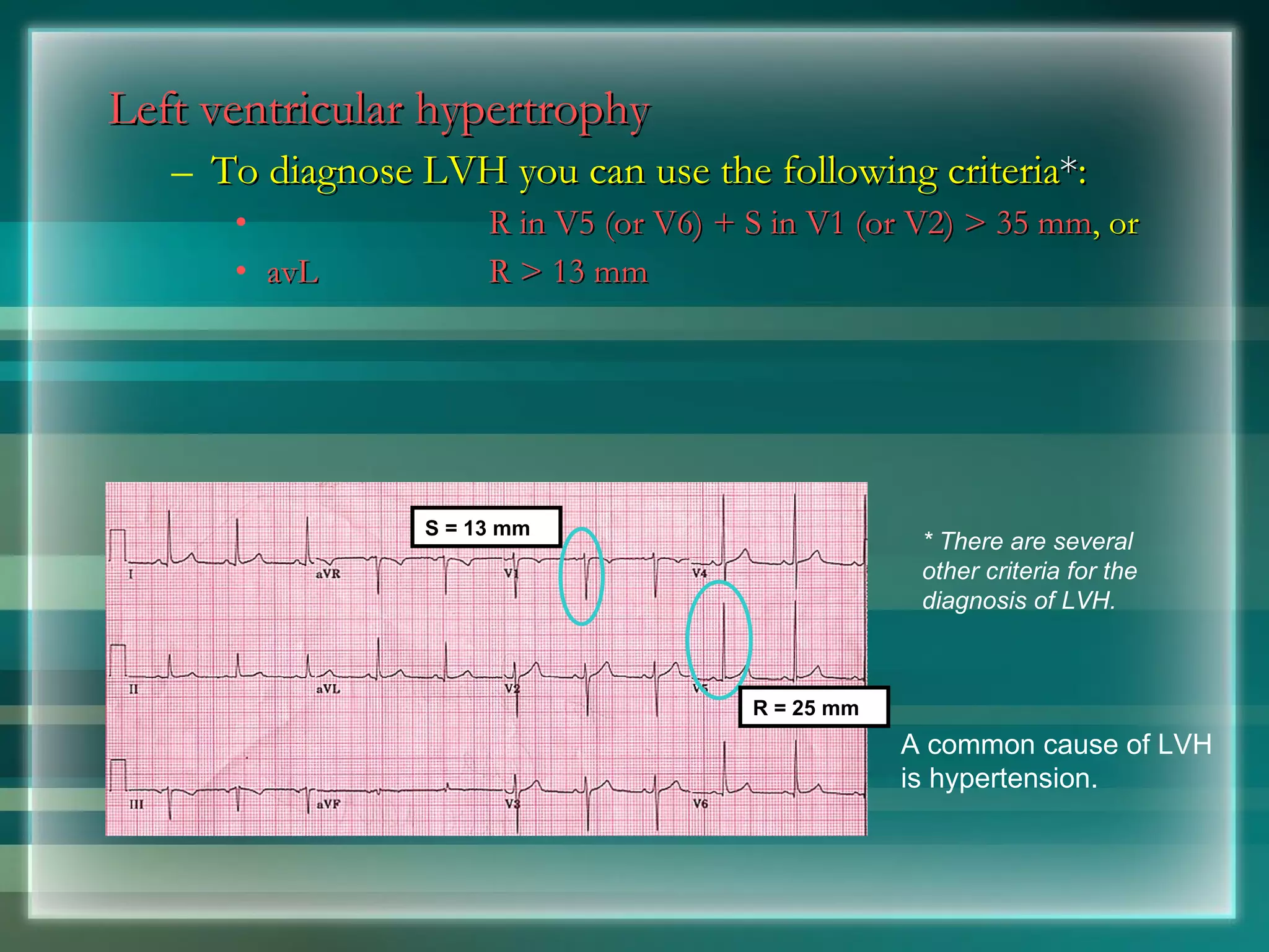 Left ventricular hypertrophy To diagnose LVH you can use the following criteria * : R in V5 (or V6) + S in V1 (or V2) > 35 mm , or avL R > 13 mm A common cause of LVH is hypertension. * There are several other criteria for the diagnosis of LVH. S = 13 mm R = 25 mm 