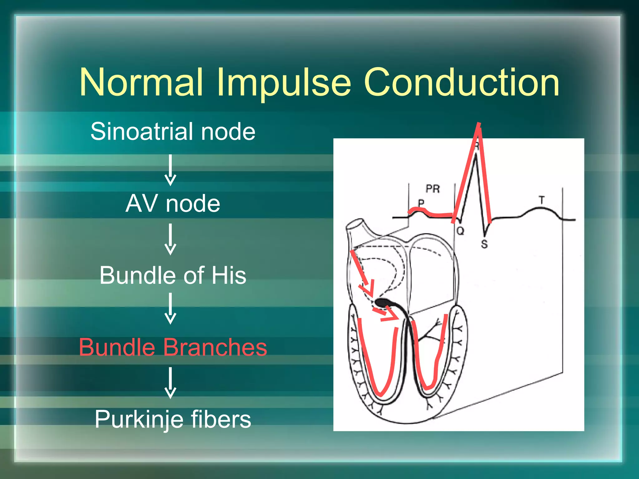 Normal Impulse Conduction Sinoatrial node AV node Bundle of His Bundle Branches Purkinje fibers 