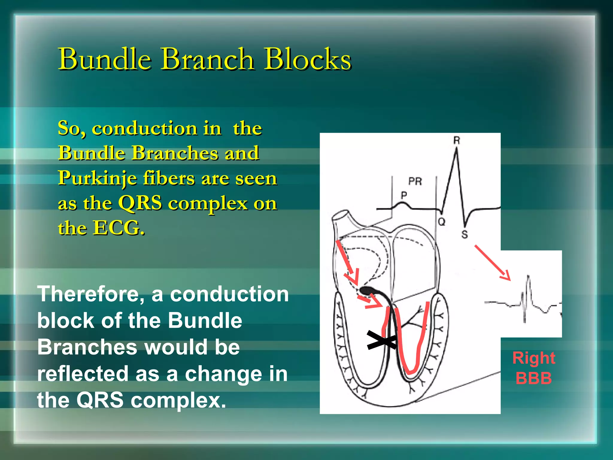 Bundle Branch Blocks So, conduction in  the Bundle Branches and Purkinje fibers are seen as the QRS complex on the ECG. Therefore, a conduction block of the Bundle Branches would be reflected as a change in the QRS complex. Right BBB 