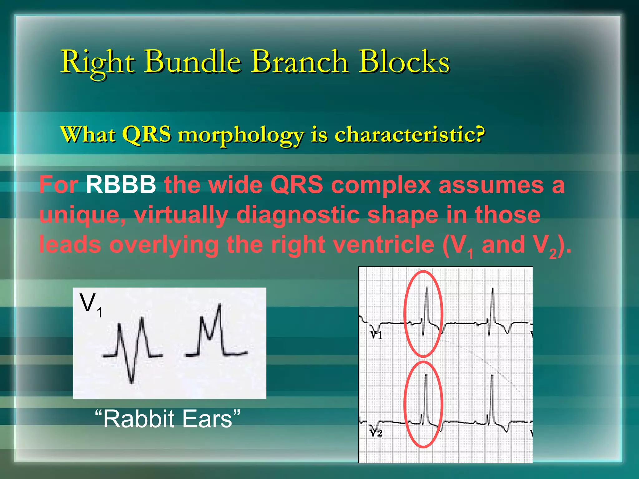 Right Bundle Branch Blocks What QRS morphology is characteristic? V 1 For  RBBB  the wide QRS complex assumes a unique, virtually diagnostic shape in those leads overlying the right ventricle (V 1  and V 2 ).  “ Rabbit Ears” 