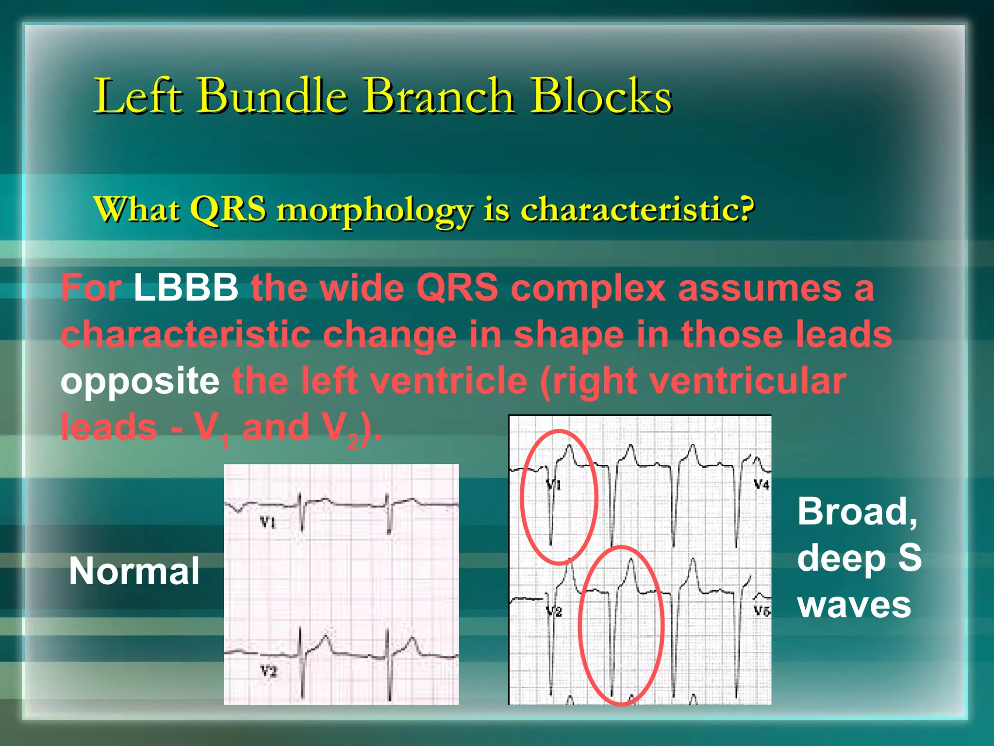 Left Bundle Branch Blocks What QRS morphology is characteristic? Normal For  LBBB  the wide QRS complex assumes a characteristic change in shape in those leads  opposite  the left ventricle (right ventricular leads - V 1  and V 2 ).  Broad, deep S waves 