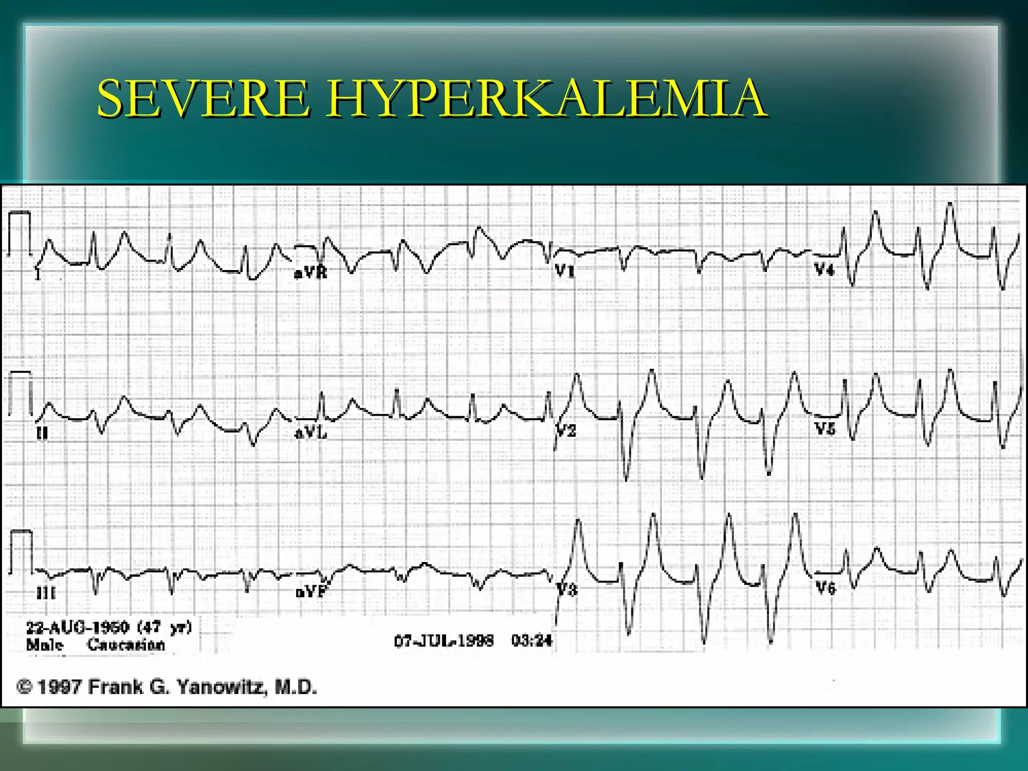 SEVERE HYPERKALEMIA 
