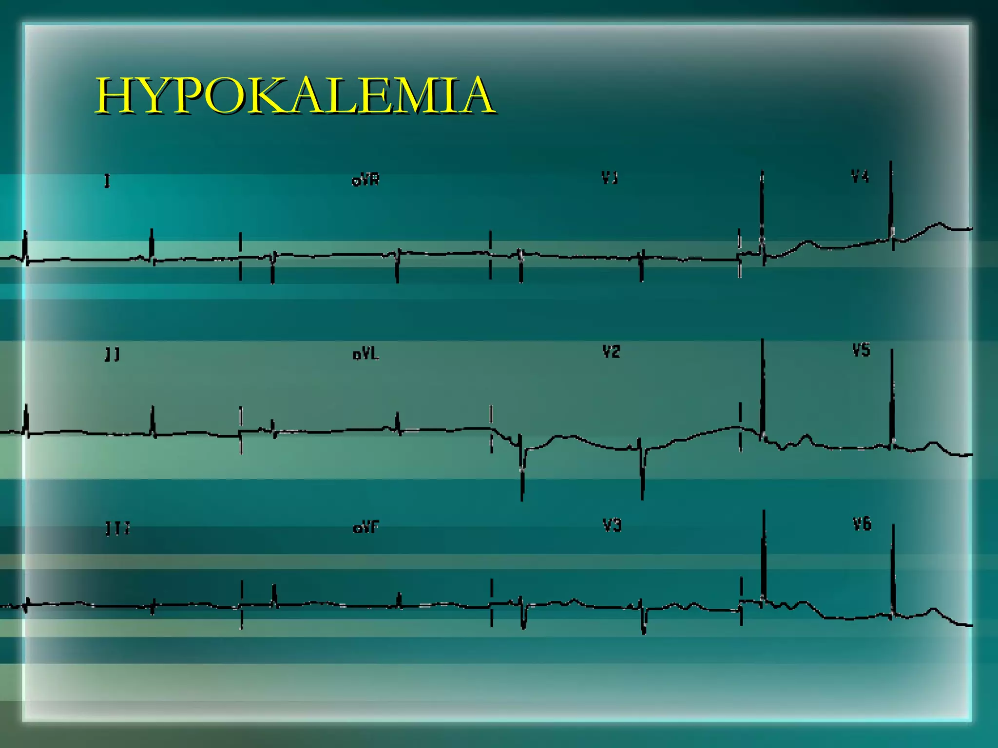 HYPOKALEMIA 