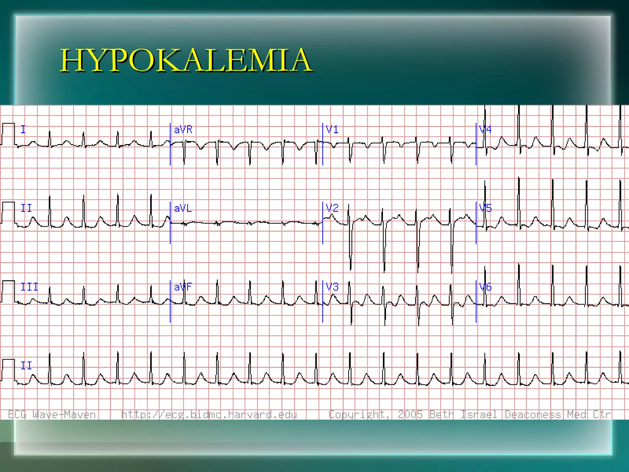 HYPOKALEMIA 