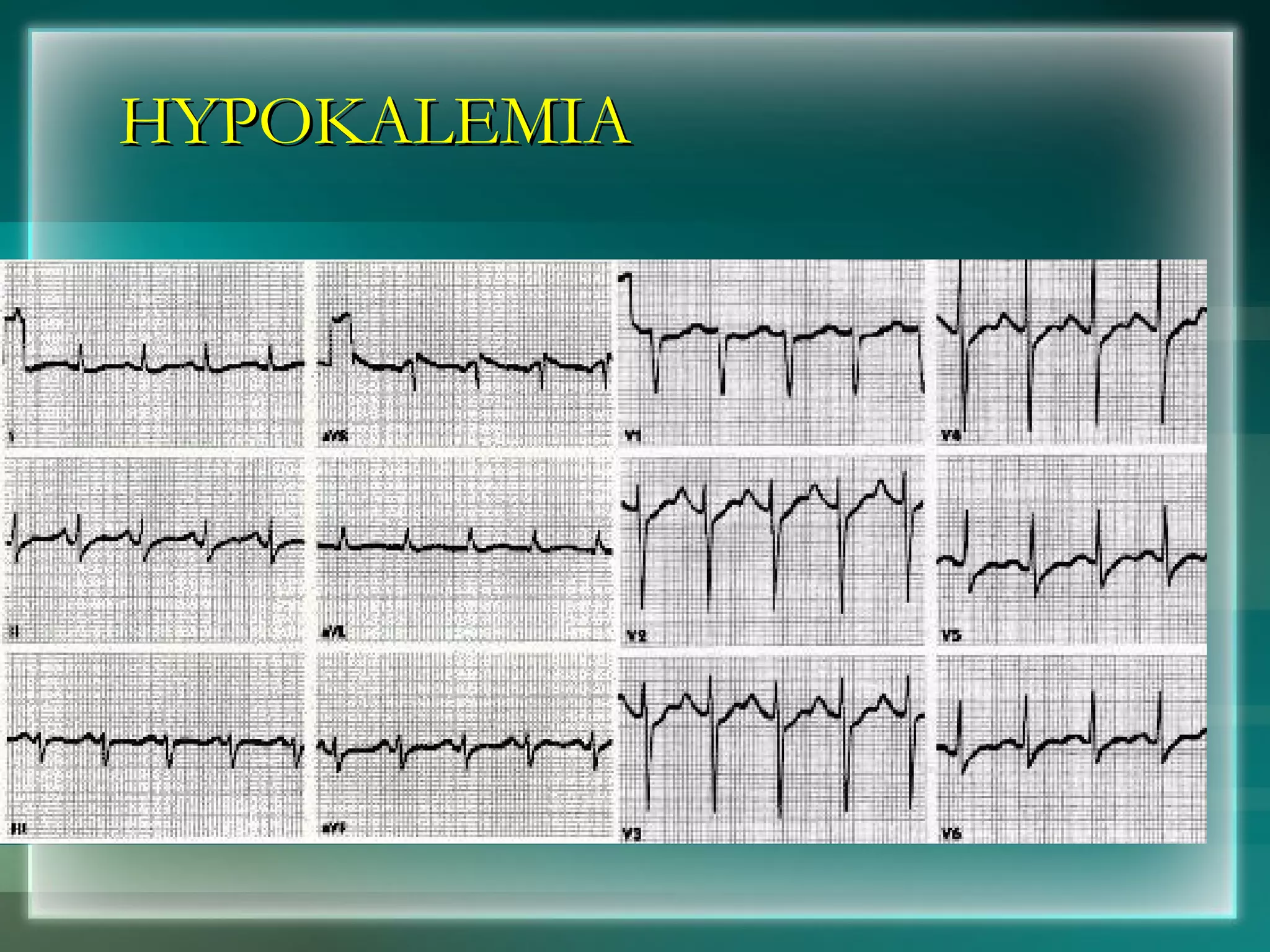 HYPOKALEMIA 