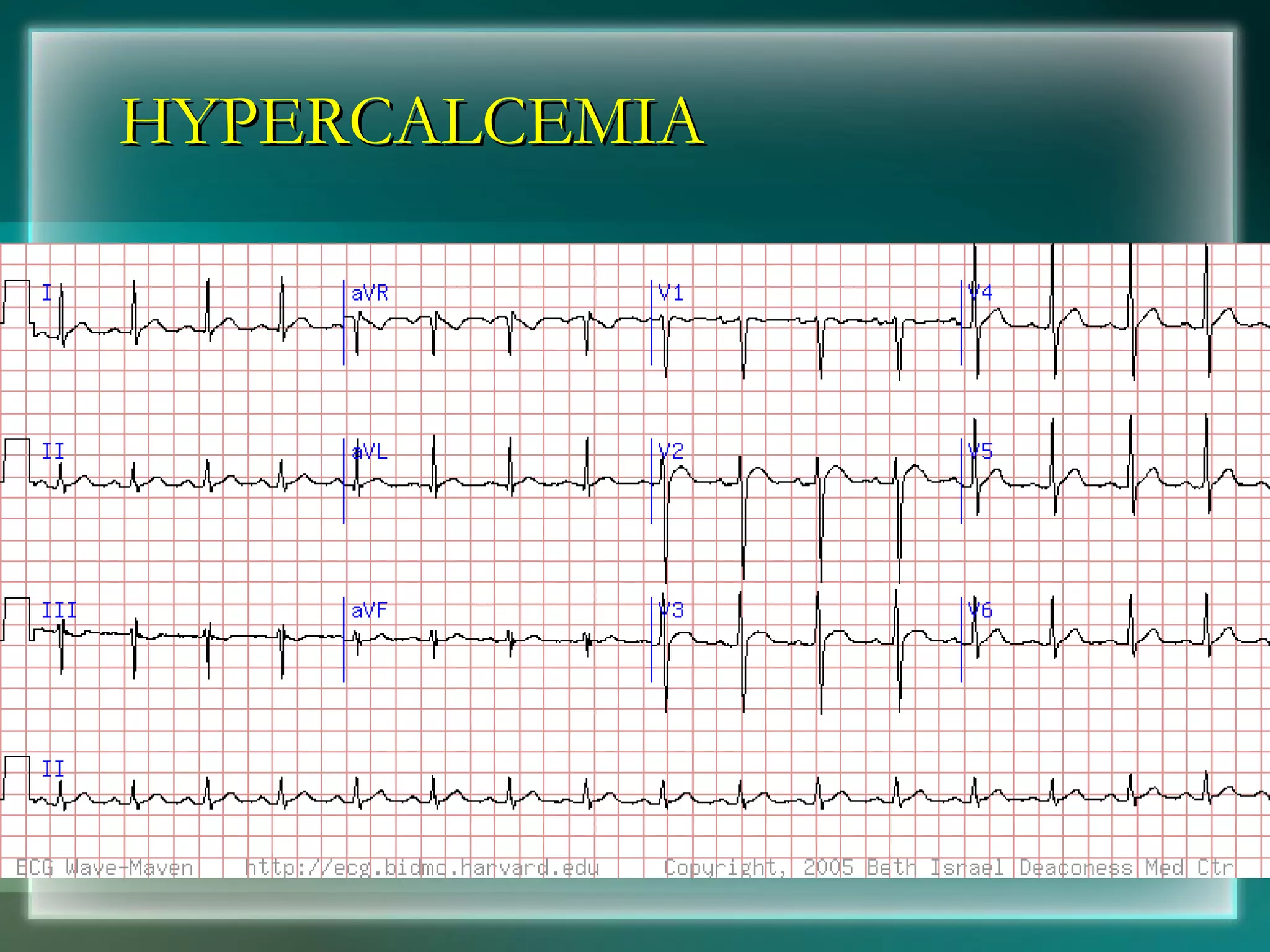 HYPERCALCEMIA 