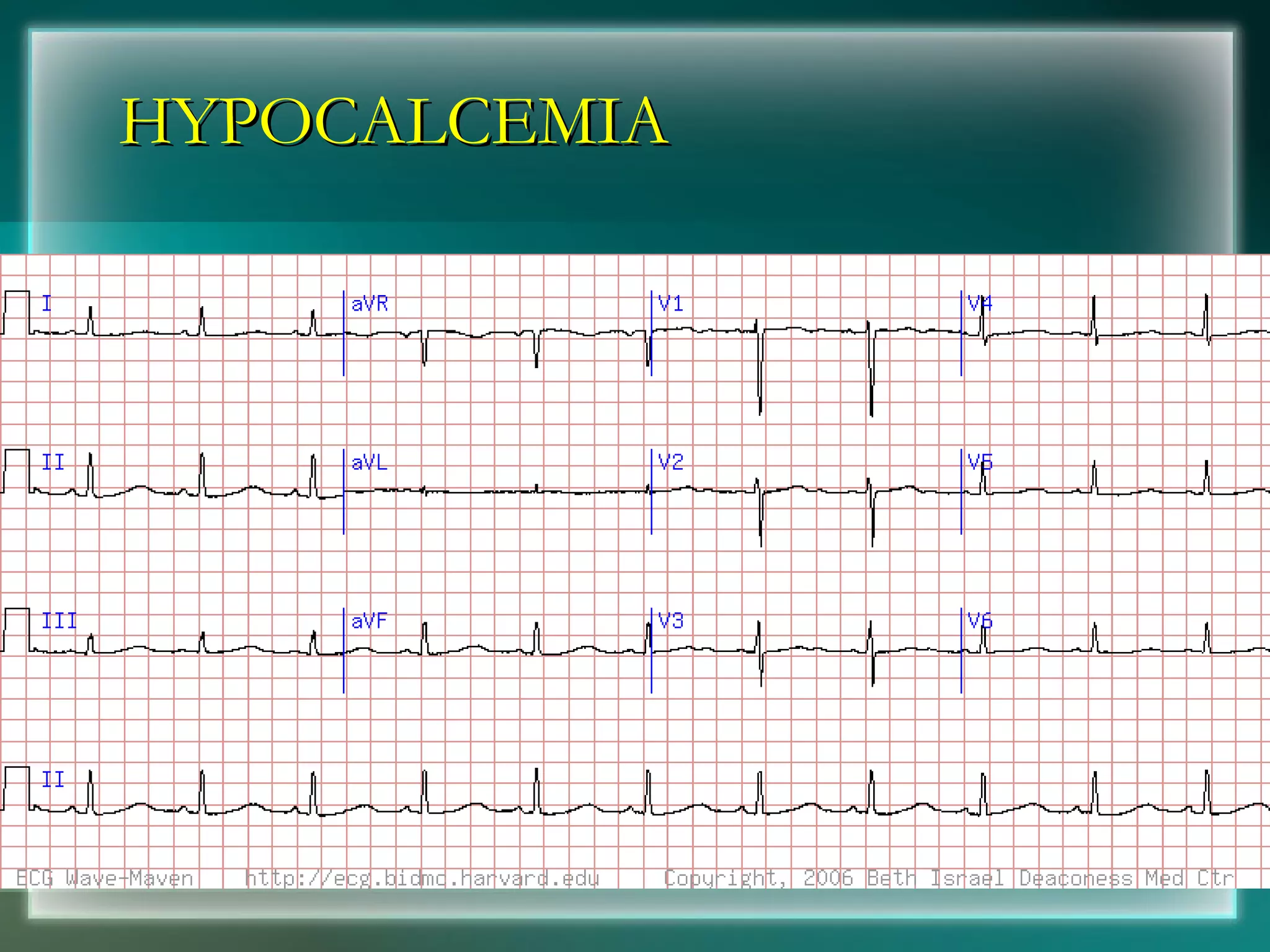 HYPOCALCEMIA 