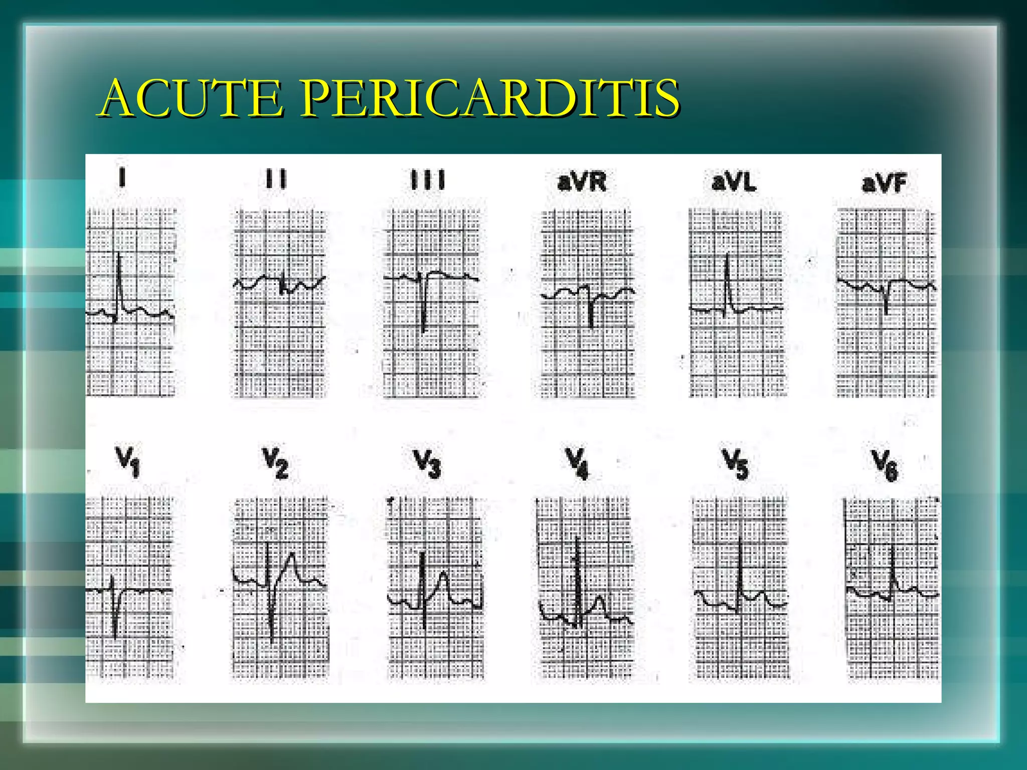 ACUTE PERICARDITIS 