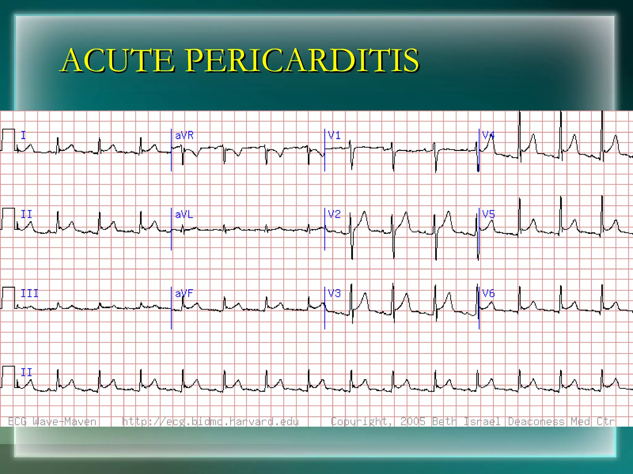 ACUTE PERICARDITIS 