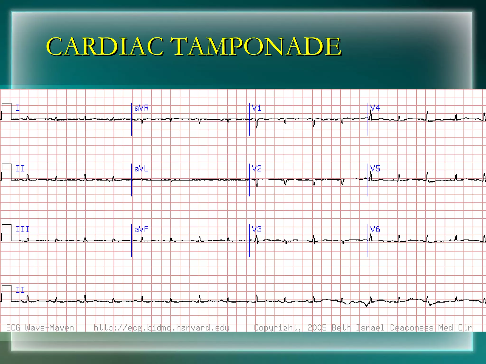 CARDIAC TAMPONADE 