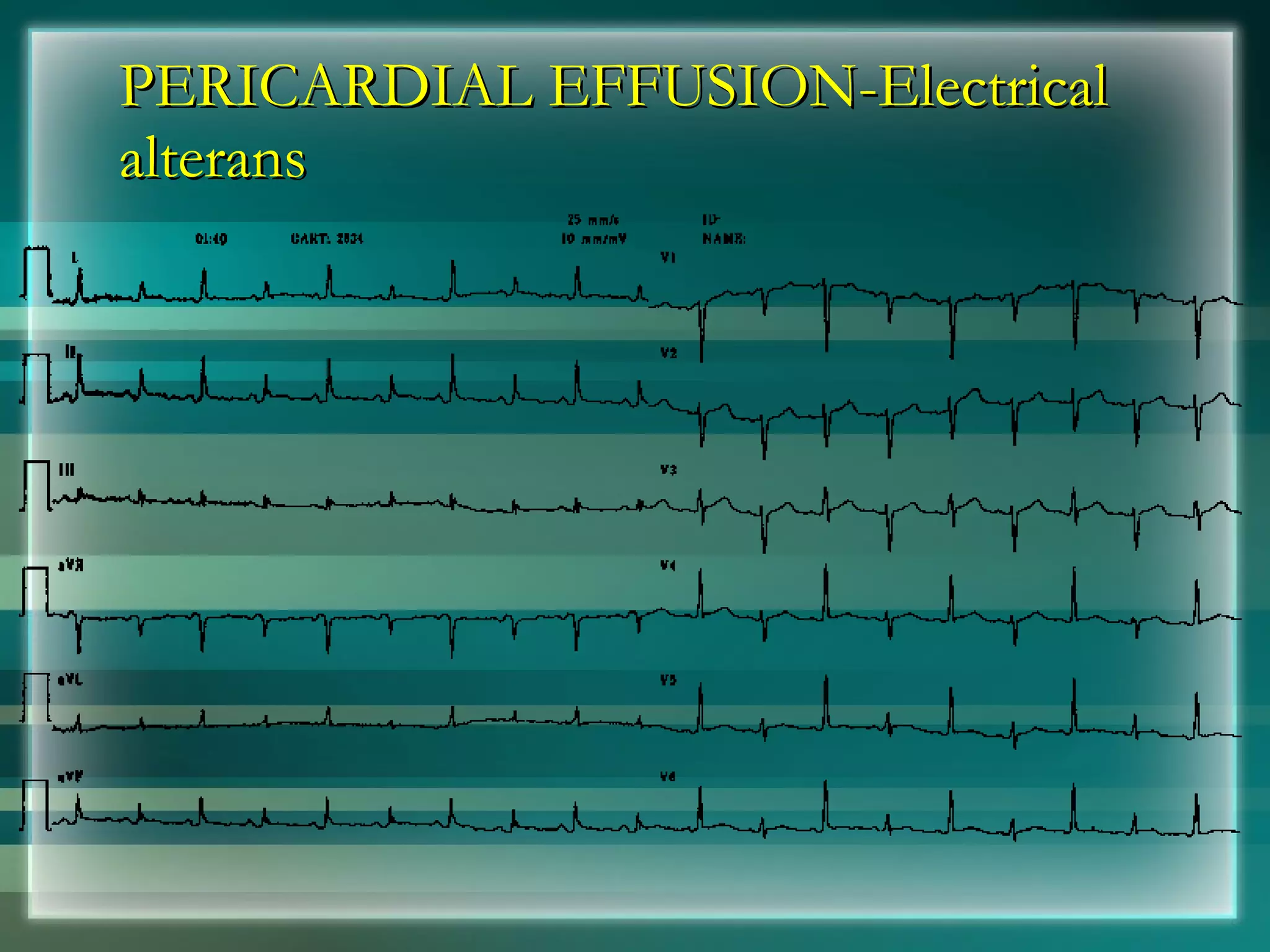 PERICARDIAL EFFUSION-Electrical alterans 