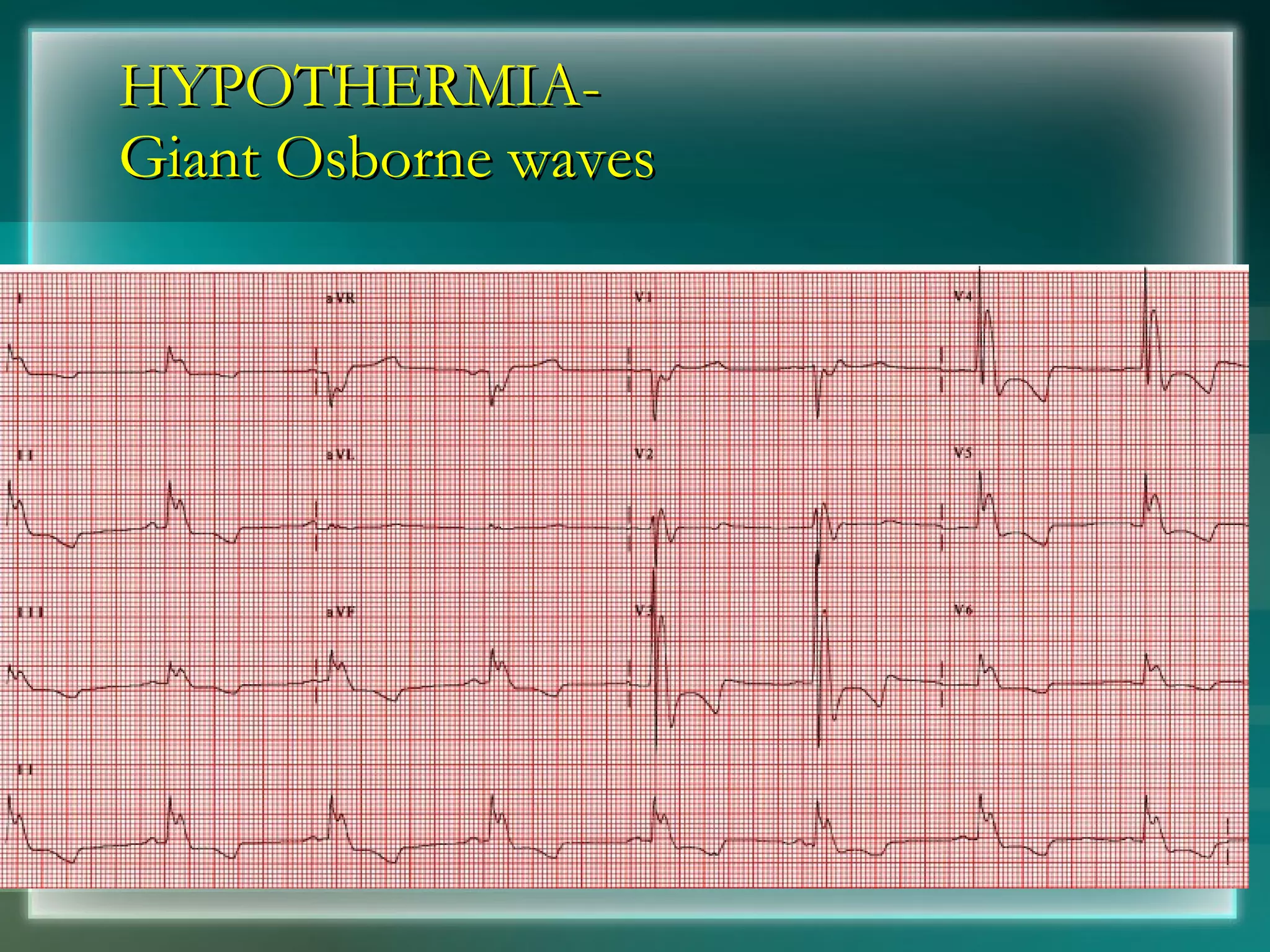 HYPOTHERMIA-  Giant Osborne waves 
