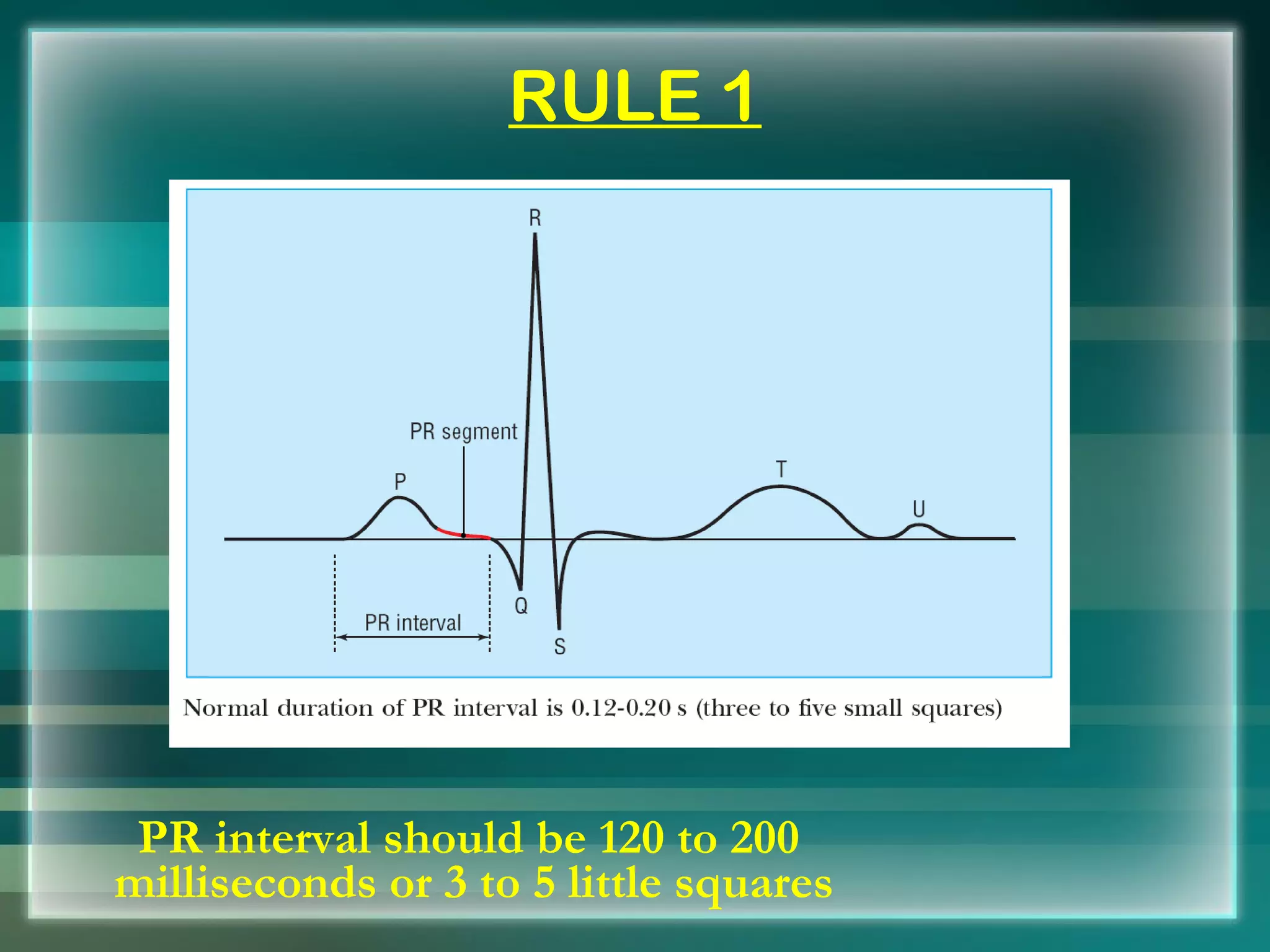 RULE 1 PR interval should be 120 to 200 milliseconds or 3 to 5 little squares 