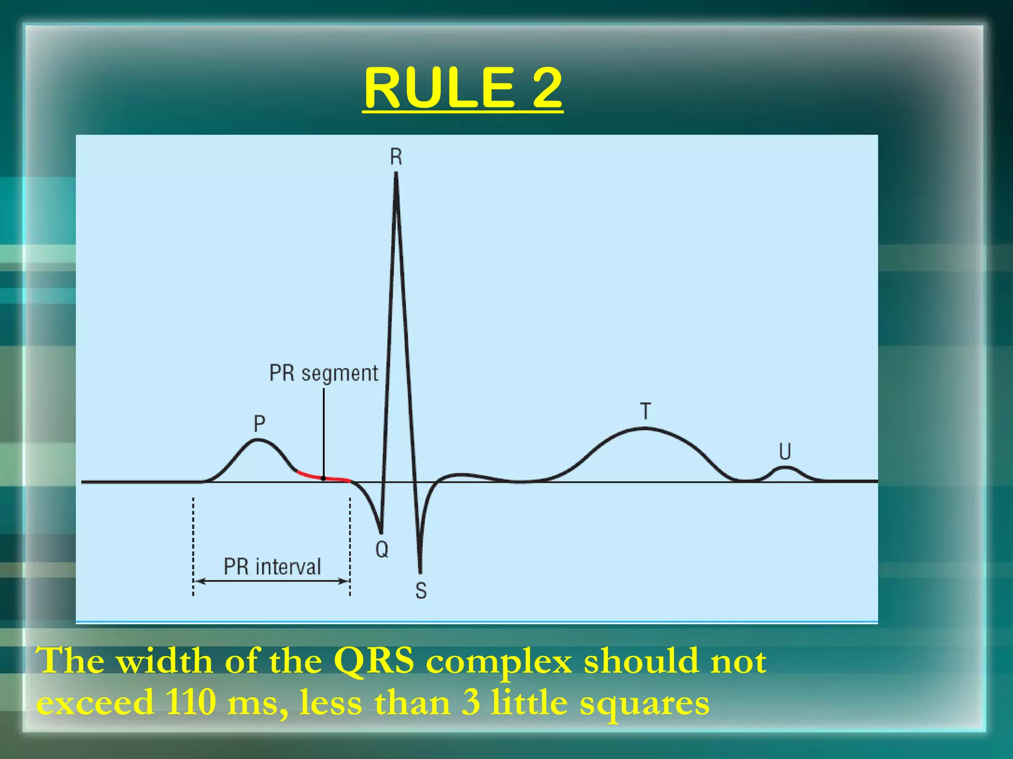   RULE 2 The width of the QRS complex should not exceed 110 ms, less than 3 little squares 