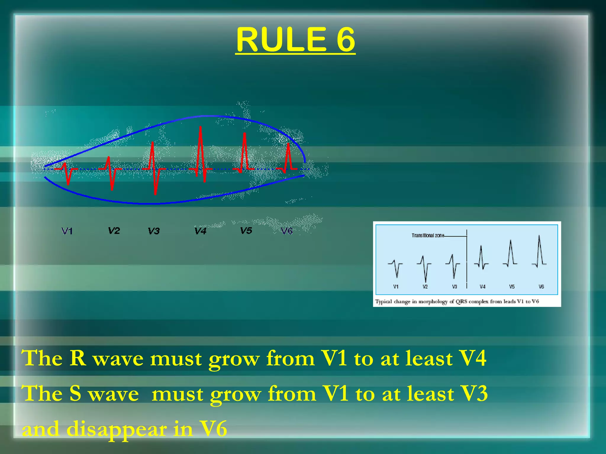 RULE 6 The R wave must grow from V1 to at least V4 The S wave  must grow from V1 to at least V3  and disappear in V6 
