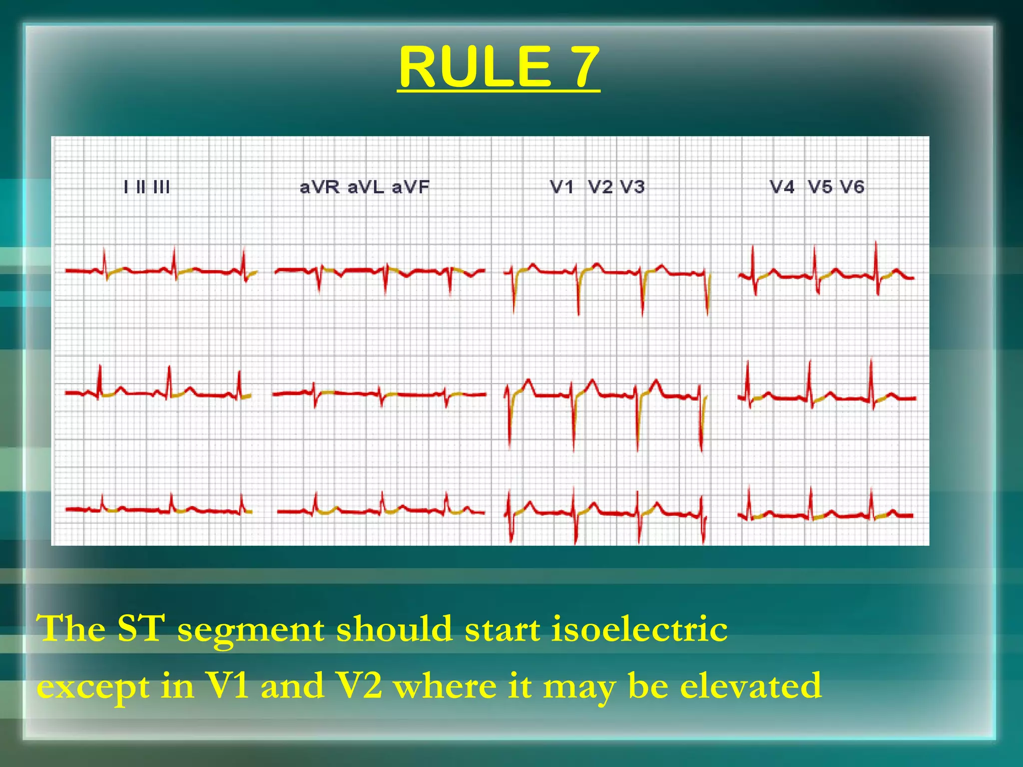 RULE 7 The ST segment should start isoelectric  except in V1 and V2 where it may be elevated 