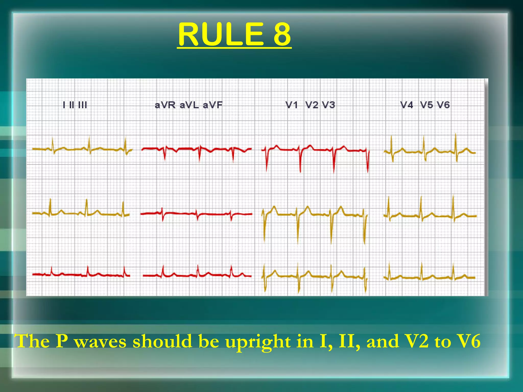 RULE 8 The P waves should be upright in I, II, and V2 to V6 
