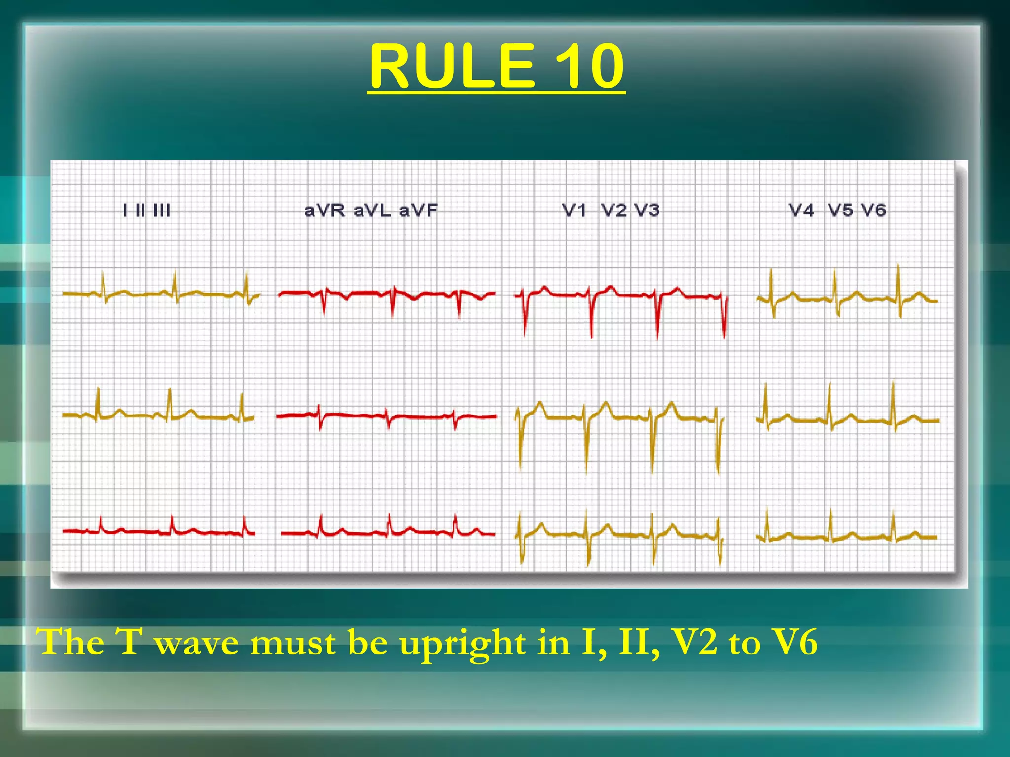 RULE 10 The T wave must be upright in I, II, V2 to V6 
