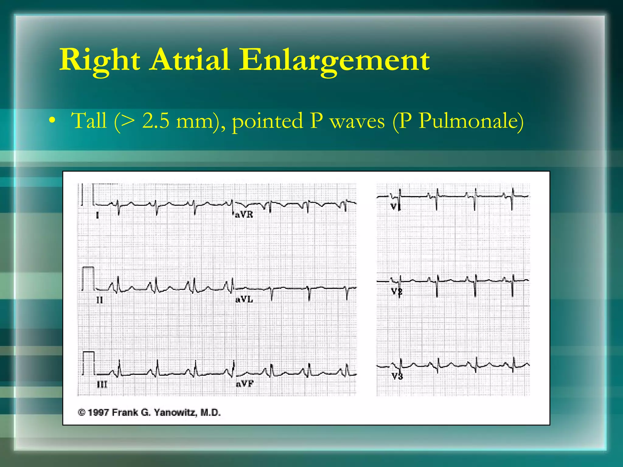 Right Atrial Enlargement Tall (> 2.5 mm), pointed P waves (P Pulmonale) 
