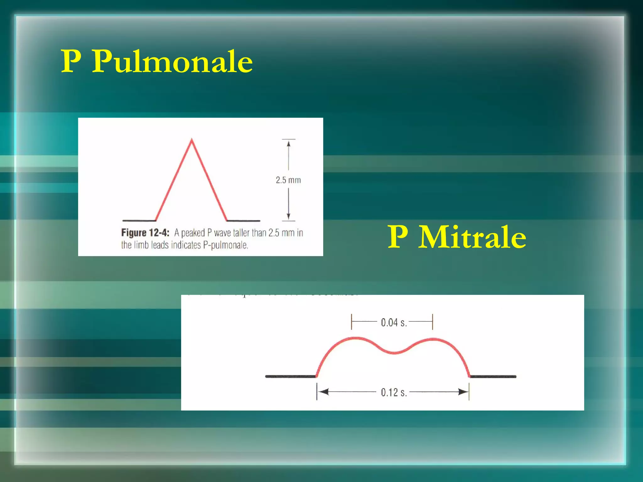 P Pulmonale P Mitrale 
