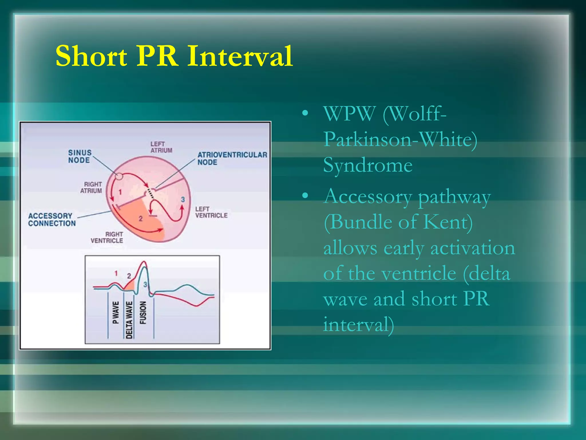 Short PR Interval WPW (Wolff-Parkinson-White) Syndrome Accessory pathway (Bundle of Kent) allows early activation of the ventricle (delta wave and short PR interval) 