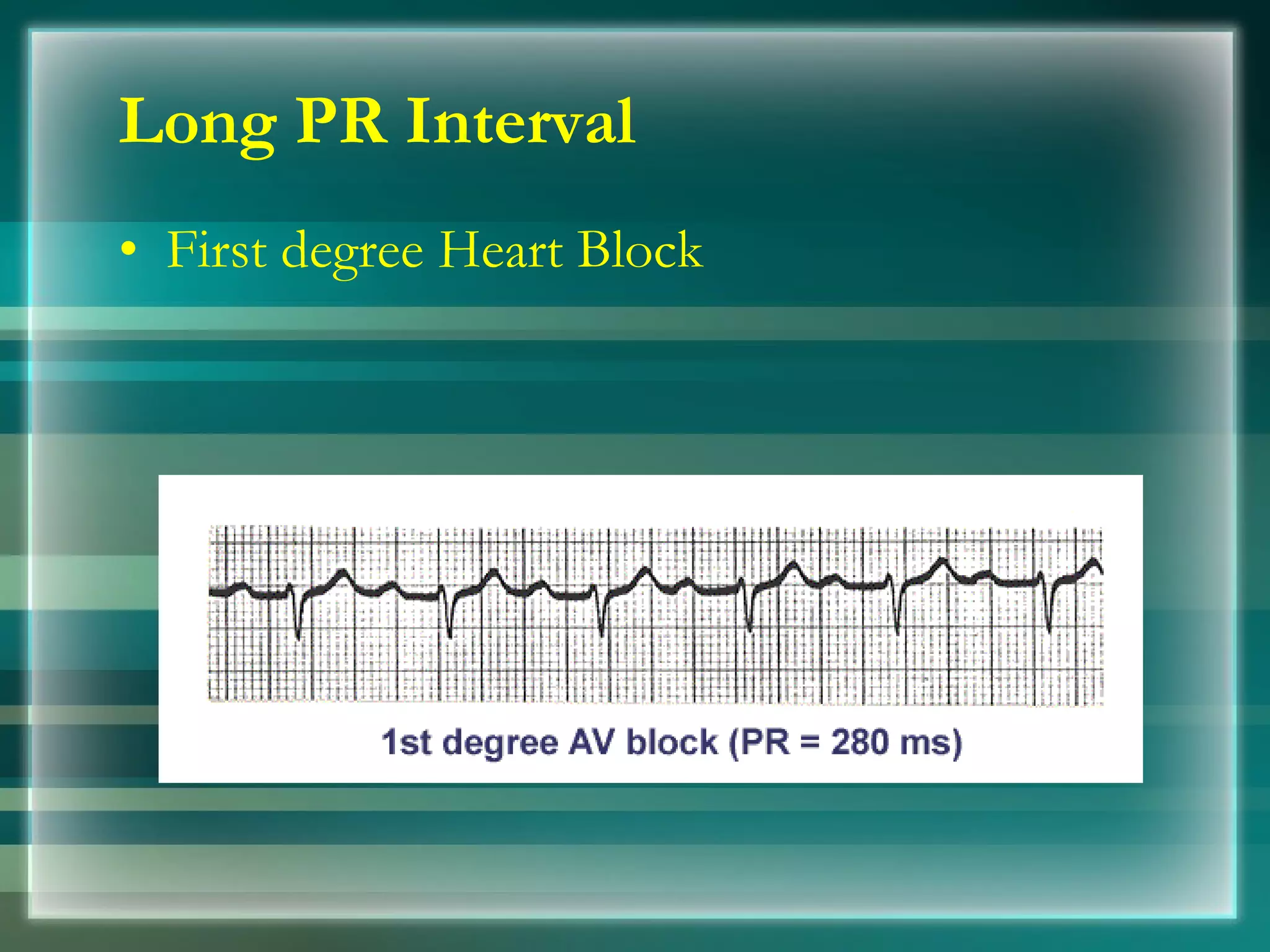 Long PR Interval First degree Heart Block 