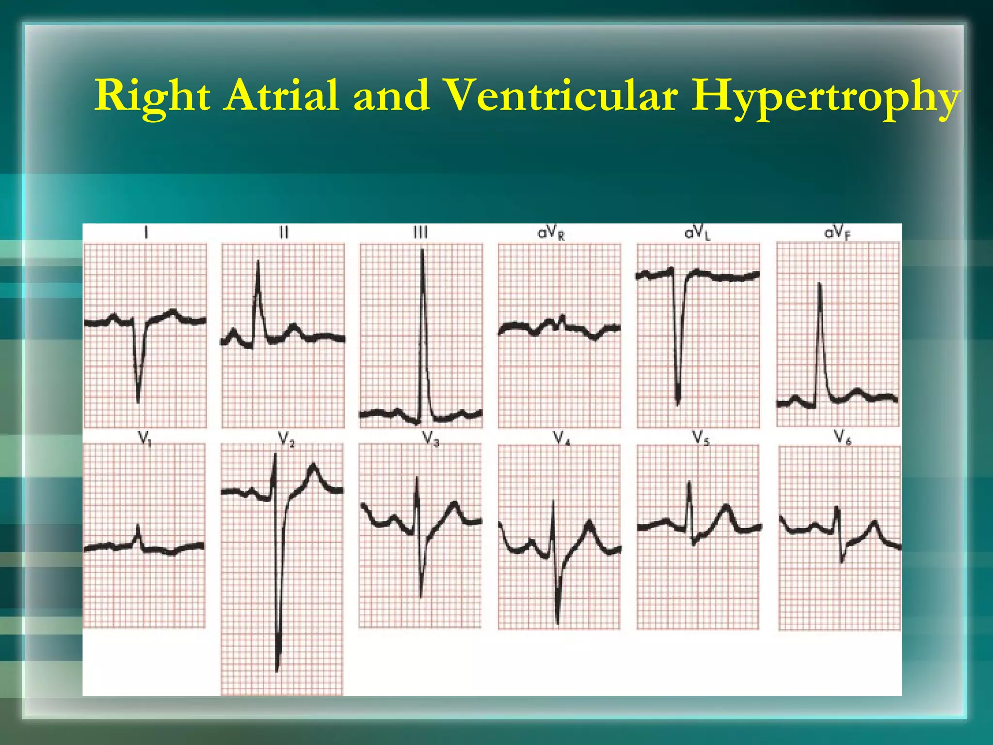 Right Atrial and Ventricular Hypertrophy 