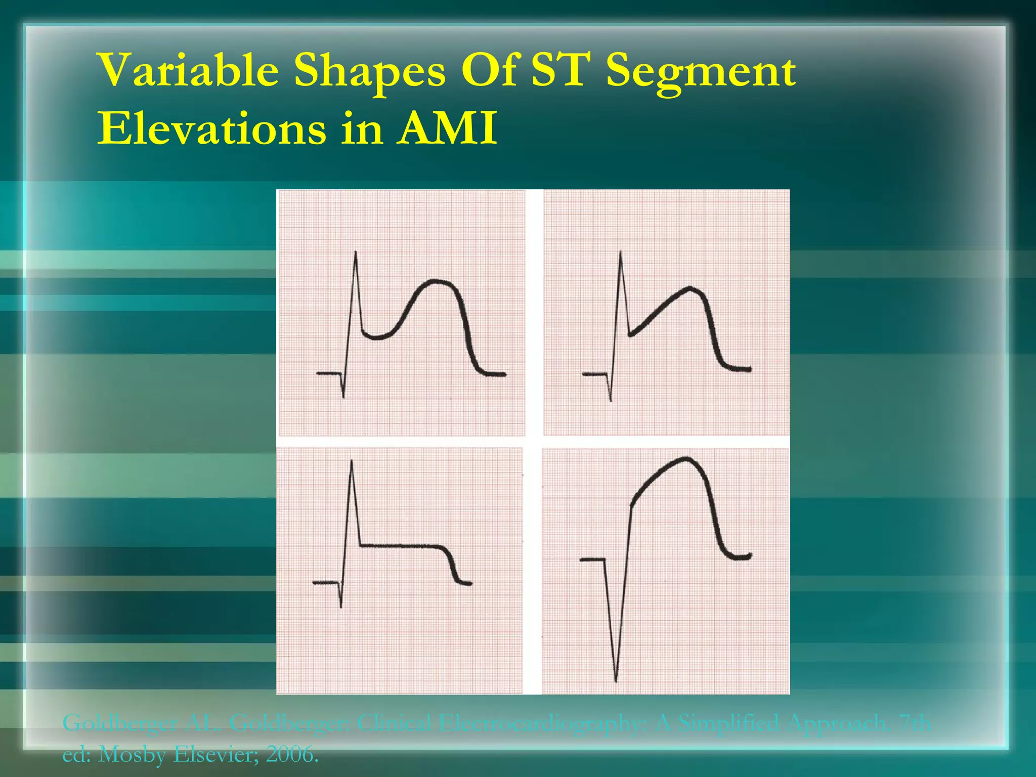 Variable Shapes Of ST Segment Elevations in AMI Goldberger AL. Goldberger: Clinical Electrocardiography: A Simplified Approach. 7th ed: Mosby Elsevier; 2006. 