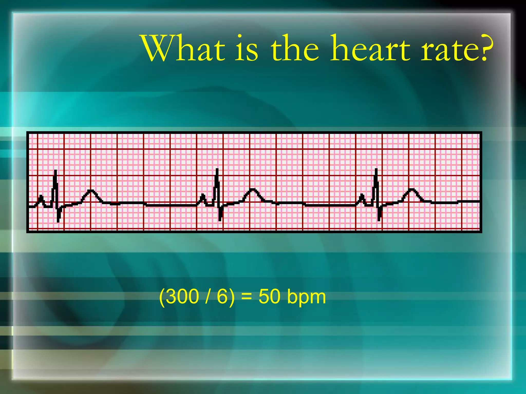 What is the heart rate? (300 / 6) = 50 bpm 