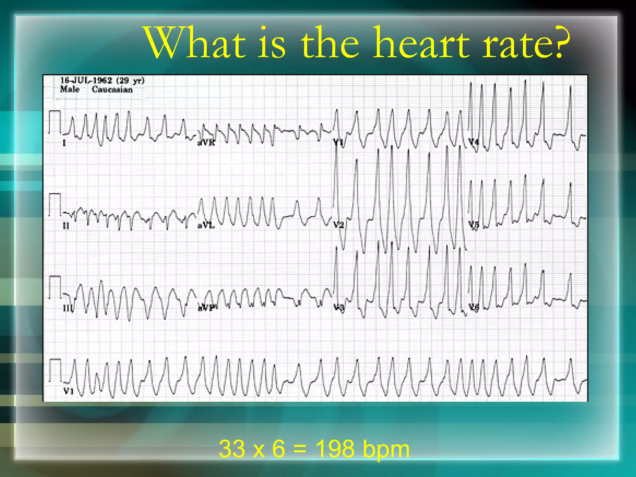 What is the heart rate? 33 x 6 = 198 bpm 