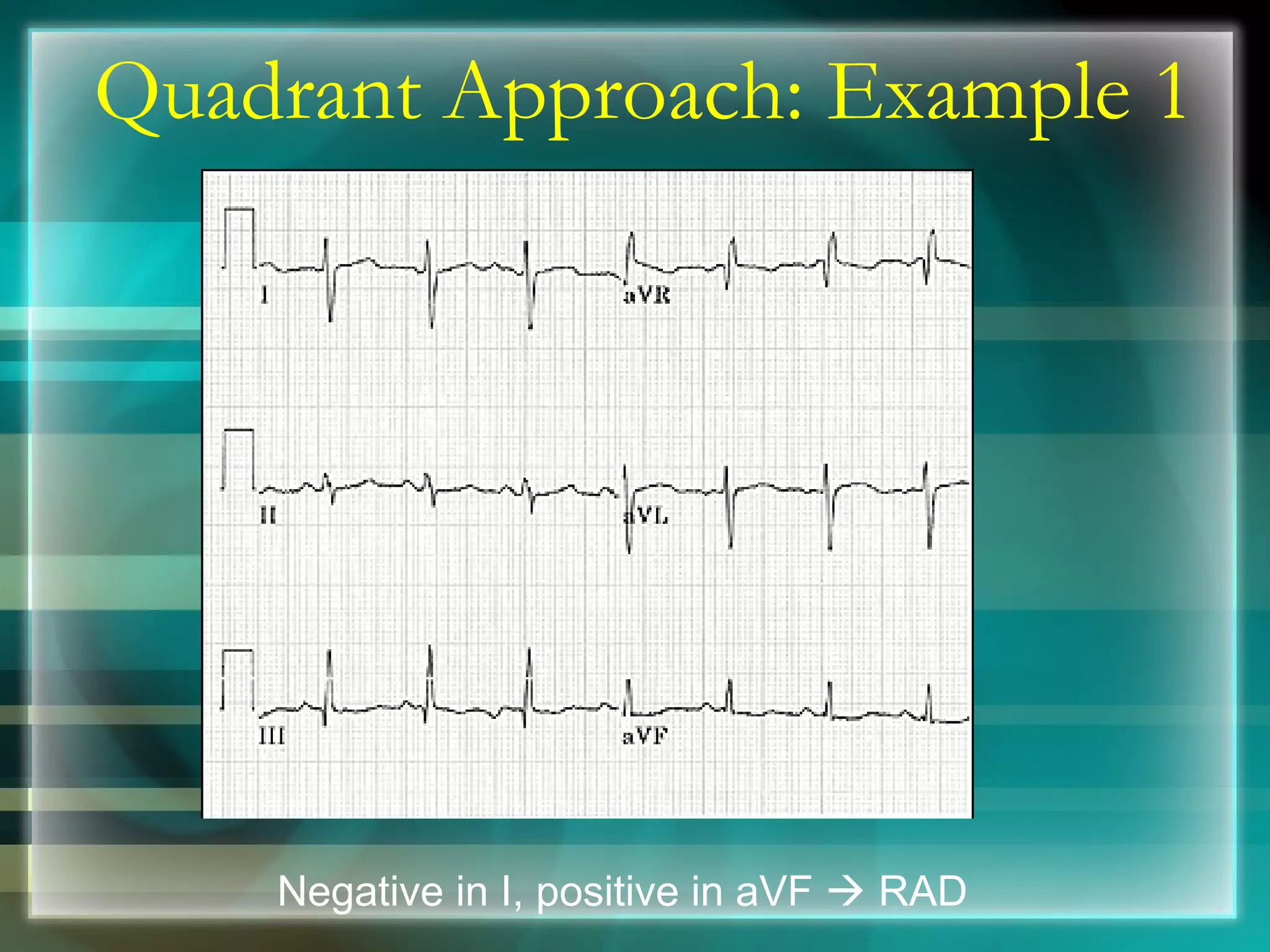Quadrant Approach: Example 1 Negative in I, positive in aVF    RAD 