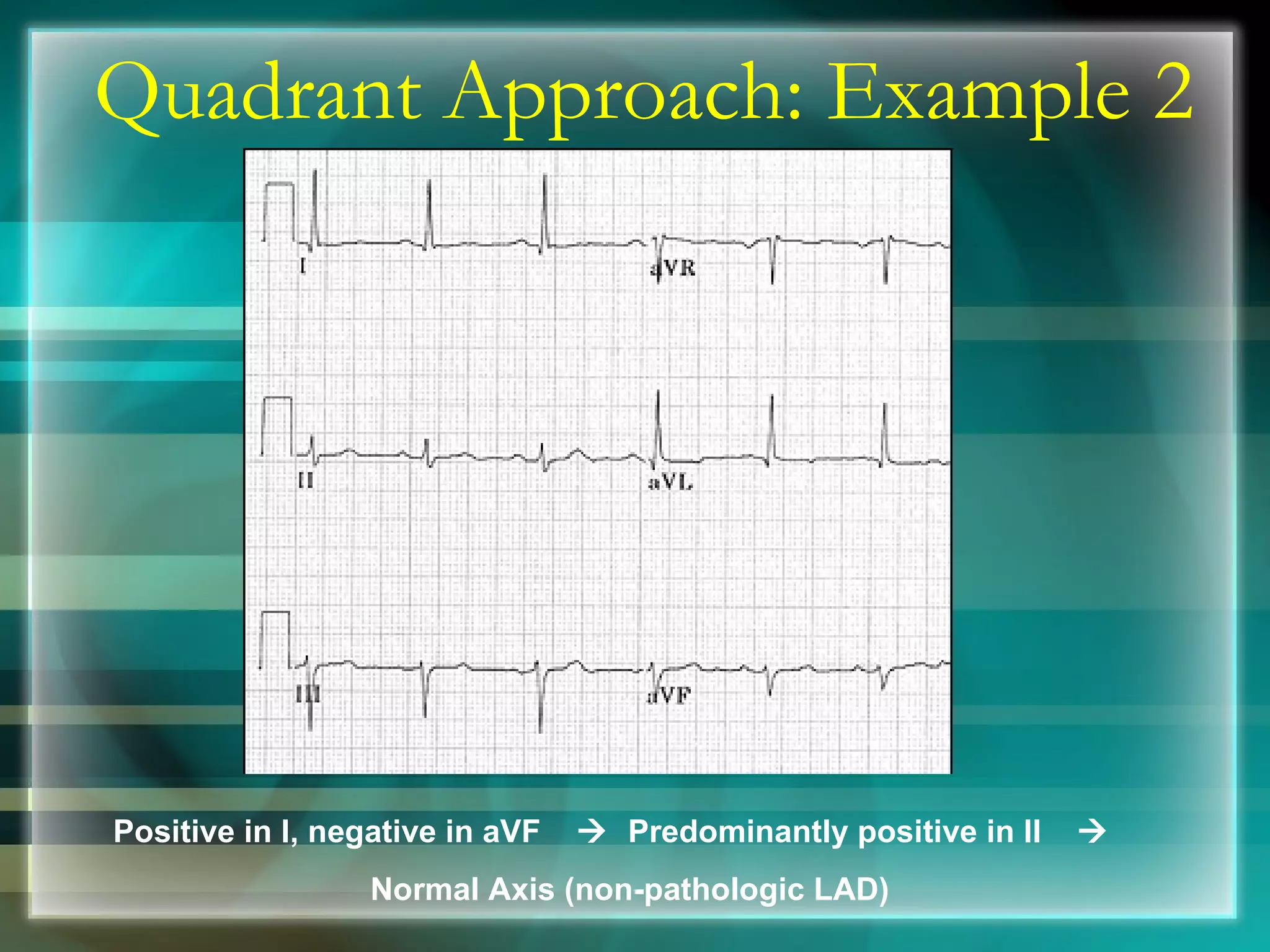 Quadrant Approach: Example 2 Positive in I, negative in aVF     Predominantly positive in II     Normal Axis (non-pathologic LAD) 